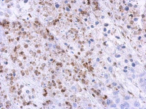 Immunohistochemical analysis of paraffin-embedded Hela xenograft, using U1SNRNPBP antibody at 1:500 dilution.