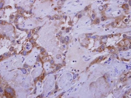 Immunohistochemical analysis of paraffin-embedded Ovarian carcinoma, using Wnt7b antibody at 1:250 dilution.