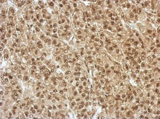 Immunohistochemical analysis of paraffin-embedded HBL435 xenograft, using ZFAT antibody at 1:500 dilution.