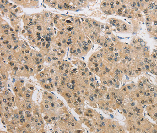 Immunohistochemistry of Human liver cancer using AMZ2 Polyclonal Antibody at dilution of 1:40
