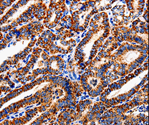 Immunohistochemistry of Human liver cancer using COX19 Polyclonal Antibody at dilution of 1:50
