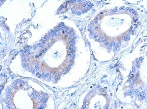 Immunohistochemical analysis of paraffin-embedded gastric ca, using CCDC28B antibody at 1:500 dilution.