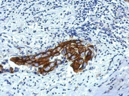 Immunohistochemical analysis of paraffin-embedded Breast ca, using IPP antibody at 1:500 dilution.