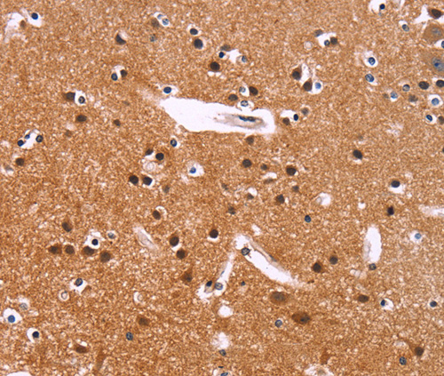 Immunohistochemistry of Human colon cancer using IRAK1BP1 Polyclonal Antibody at dilution of 1:40