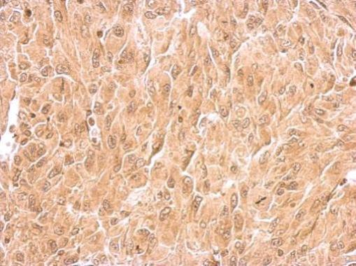 RIN2 antibody detects RIN2 protein at cytosol on hepatoma by immunohistochemical analysis. Sample: Paraffin-embedded U87 xenograft. RIN2 antibody dilution: 1:500.