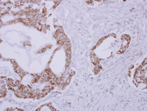 RLBP1L1 antibody detects CLVS1 protein at cytosol on Lung adenocarcinoma by immunohistochemical analysis. Sample: Paraffin-embedded Lung adenocarcinoma. RLBP1L1 antibody dilution: 1:500.