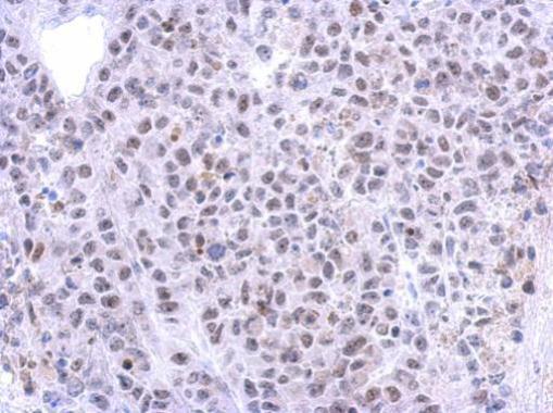 Immunohistochemical analysis of paraffin-embedded Hela xenograft, using RRP12 antibody at 1:500 dilution.