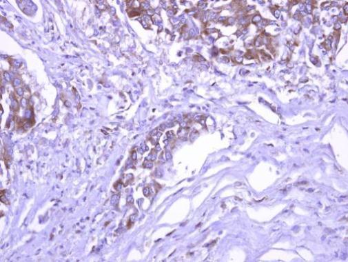 SEC3 antibody detects EXOC1 protein at cytoplasm on Colon cancer xenograft by immunohistochemical analysis. Sample: Paraffin-embedded Colon cancer xenograft. SEC3 antibody dilution: 1:500.