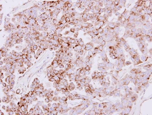 Immunohistochemical analysis of paraffin-embedded OVCAR3 xenograft, using SLC25A22 antibody at 1:500 dilution.
