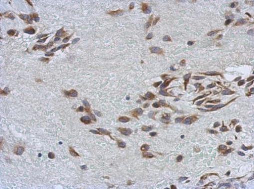 Immunohistochemical analysis of paraffin-embedded Hepatoma, using SSFA2 antibody at 1:500 dilution.