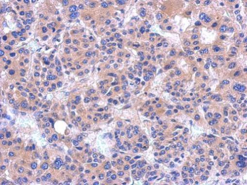 Immunohistochemical analysis of paraffin-embedded hepatoma, using PDZRN4 antibody at 1:500 dilution.