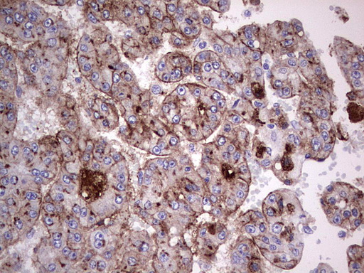 IHC of paraffin-embedded Carcinoma of Human liver tissue using anti-ASPA mouse monoclonal antibody. (Heat-induced epitope retrieval by 1 mM EDTA in 10mM Tris, pH8.5, 120°C for 3min).
