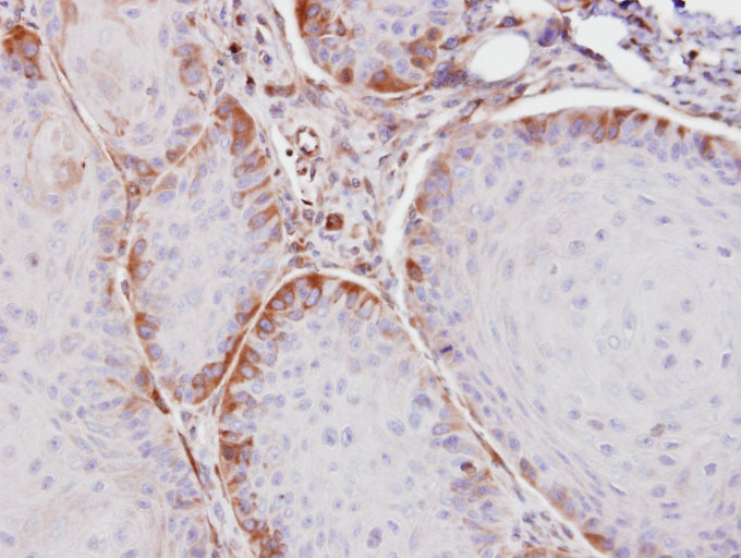 Immunohistochemical analysis of paraffin-embedded Cal27 xenograft using ASS1 antibody at 1:100 dilution.