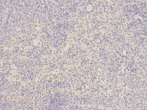Immunohistochemistry of paraffin-embedded human lung cancer using ATF6 antibody at dilution of 1:200 (200x lens).
