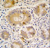 Formalin-fixed and paraffin-embedded human colon carcinoma tissue reacted with Autophagy APG16L antibody , which was peroxidase-conjugated to the secondary antibody, followed by DAB staining. This data demonstrates the use of this antibody for immunohistochemistry; clinical relevance has not been evaluated.