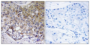 IHC of paraffin-embedded human breast carcinoma tissue, using ATG4A Antibody. The picture on the right is treated with the synthesized peptide.