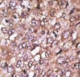 Formalin-fixed and paraffin-embedded human cancer tissue reacted with the primary antibody, which was peroxidase-conjugated to the secondary antibody, followed by AEC staining. This data demonstrates the use of this antibody for immunohistochemistry; clinical relevance has not been evaluated. BC = breast carcinoma; HC = hepatocarcinoma.