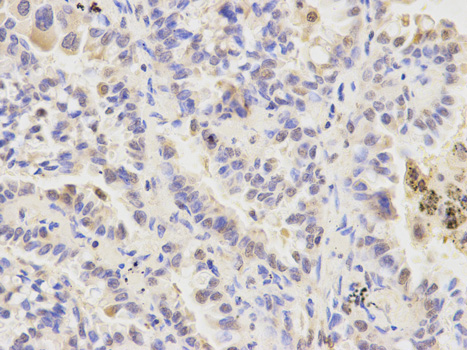 Immunohistochemistry of paraffin-embedded human lung cancer using ATG4A antibody at dilution of 1:200 (400x lens).