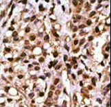 Formalin-fixed and paraffin-embedded human cancer tissue reacted with the primary antibody, which was peroxidase-conjugated to the secondary antibody, followed by DAB staining. This data demonstrates the use of this antibody for immunohistochemistry; clinical relevance has not been evaluated. BC = breast carcinoma; HC = hepatocarcinoma.
