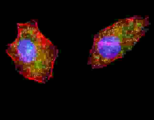 Fluorescent image of U251 cells stained with ATG4D antibody. U251 cells were treated with Chloroquine (50 mu M,16h), then fixed with 4% PFA (20 min), permeabilized with Triton X-100 (0.2%, 30 min). Cells were then incubated ATG4D primary antibody (1:200, 2 h at room temperature). For secondary antibody, Alexa Fluor 488 conjugated donkey anti-rabbit antibody (green) was used (1:1000, 1h). Cytoplasmic actin was counterstained with Alexa Fluor 555 (red) conjugated Phalloidin (5.25 mu M, 25 min). Nuclei were counterstained with Hoechst 33342 (blue) (10 ug/ml, 5 min). Pictures were taken on a Biorevo microscope (BZ-900, Keyence). ATG4D immunoreactivity is localized to autophagic vacuoles in the cytoplasm of U251 cells.
