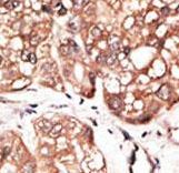 Formalin-fixed and paraffin-embedded human cancer tissue reacted with the primary antibody, which was peroxidase-conjugated to the secondary antibody, followed by AEC staining. This data demonstrates the use of this antibody for immunohistochemistry; clinical relevance has not been evaluated. BC = breast carcinoma; HC = hepatocarcinoma.