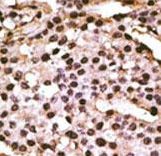 Formalin-fixed and paraffin-embedded human cancer tissue reacted with the primary antibody, which was peroxidase-conjugated to the secondary antibody, followed by DAB staining. This data demonstrates the use of this antibody for immunohistochemistry; clinical relevance has not been evaluated. BC = breast carcinoma; HC = hepatocarcinoma.