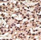 Formalin-fixed and paraffin-embedded human cancer tissue reacted with the primary antibody, which was peroxidase-conjugated to the secondary antibody, followed by DAB staining. This data demonstrates the use of this antibody for immunohistochemistry; clinical relevance has not been evaluated. BC = breast carcinoma; HC = hepatocarcinoma.