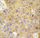 Formalin-fixed and paraffin-embedded human hepatocarcinoma tissue reacted with AARS antibody , which was peroxidase-conjugated to the secondary antibody, followed by DAB staining. This data demonstrates the use of this antibody for immunohistochemistry; clinical relevance has not been evaluated.