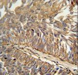 ATP13A3 antibody immunohistochemistry of formalin-fixed and paraffin-embedded human bladder carcinoma followed by peroxidase-conjugated secondary antibody and DAB staining.