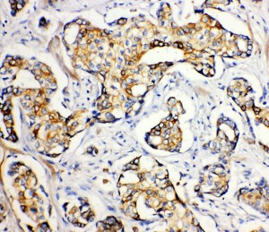 ATP2A2 / SERCA2 antibody. IHC(P): Human Breast Cancer Tissue.