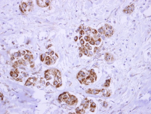 ATP synthase delta antibody detects ATP5D protein at mitochondria on breast carcinoma by immunohistochemical analysis. Sample: Paraffin-embedded breast carcinoma. ATP synthase delta antibody dilution:1:250.