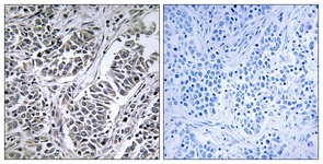 IHC of paraffin-embedded human lung carcinoma tissue, using ATP5D Antibody. The picture on the right is treated with the synthesized peptide.