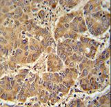 ATP5D antibody immunohistochemistry of formalin-fixed and paraffin-embedded human hepatocarcinoma followed by peroxidase-conjugated secondary antibody and DAB staining.