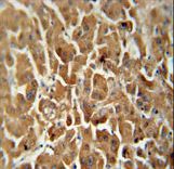 ATP5G2 antibody immunohistochemistry of formalin-fixed and paraffin-embedded human hepatocarcinoma followed by peroxidase-conjugated secondary antibody and DAB staining.