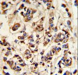 ATP6V1A Antibody IHC of formalin-fixed and paraffin-embedded breast carcinoma followed by peroxidase-conjugated secondary antibody and DAB staining.