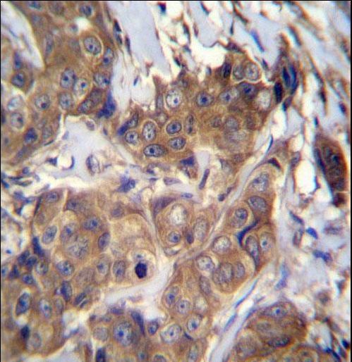 ATP6V1B1 Antibody immunohistochemistry of formalin-fixed and paraffin-embedded human breast carcinoma followed by peroxidase-conjugated secondary antibody and DAB staining.