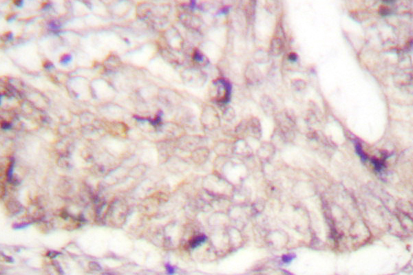 IHC of ATRIP (D64) pAb in paraffin-embedded human lung colon carcinoma tissue.