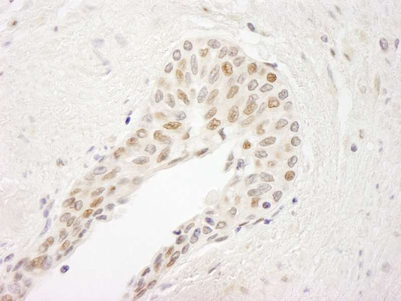 Detection of Human ATRIP by Immunohistochemistry. Sample: FFPE section of human prostate carcinoma. Antibody: Affinity purified rabbit anti-ATRIP used at a dilution of 1:250.