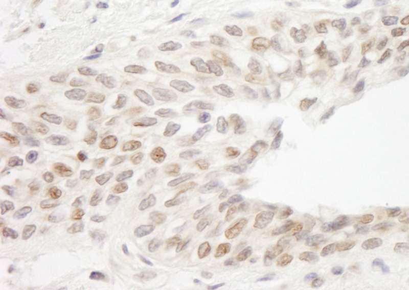 Detection of Human ATRIP by Immunohistochemistry. Sample: FFPE section of human prostate carcinoma. Antibody: Affinity purified rabbit anti-ATRIP used at a dilution of 1:1000 (1 ug/ml).