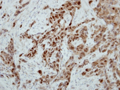 IHC of paraffin-embedded H661 xenograft using Ataxin 3 antibody at 1:500 dilution.