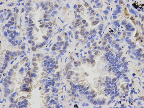 Immunohistochemistry of paraffin-embedded human lung cancer using ATXN3 antibody at dilution of 1:200 (400x lens).