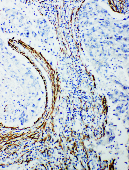 ATXN3 / JOS antibody. IHC(P): Human Lung Cancer Tissue.