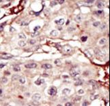 Formalin-fixed and paraffin-embedded human cancer tissue reacted with the primary antibody, which was peroxidase-conjugated to the secondary antibody, followed by DAB staining. This data demonstrates the use of this antibody for immunohistochemistry; clinical relevance has not been evaluated. BC = breast carcinoma; HC = hepatocarcinoma.