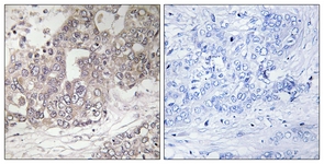 IHC of paraffin-embedded human liver carcinoma tissue, using ATG4C Antibody. The picture on the right is treated with the synthesized peptide.