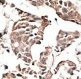 Formalin-fixed and paraffin-embedded human cancer tissue reacted with the primary antibody, which was peroxidase-conjugated to the secondary antibody, followed by AEC staining. This data demonstrates the use of this antibody for immunohistochemistry; clinical relevance has not been evaluated. BC = breast carcinoma; HC = hepatocarcinoma.