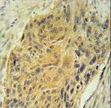 AVP Antibody immunohistochemistry of formalin-fixed and paraffin-embedded human lung carcinoma followed by peroxidase-conjugated secondary antibody and DAB staining.