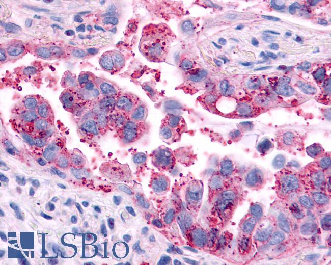 Anti-AVPR2 / V2R antibody IHC of human Lung, Adenocarcinoma. Immunohistochemistry of formalin-fixed, paraffin-embedded tissue after heat-induced antigen retrieval.