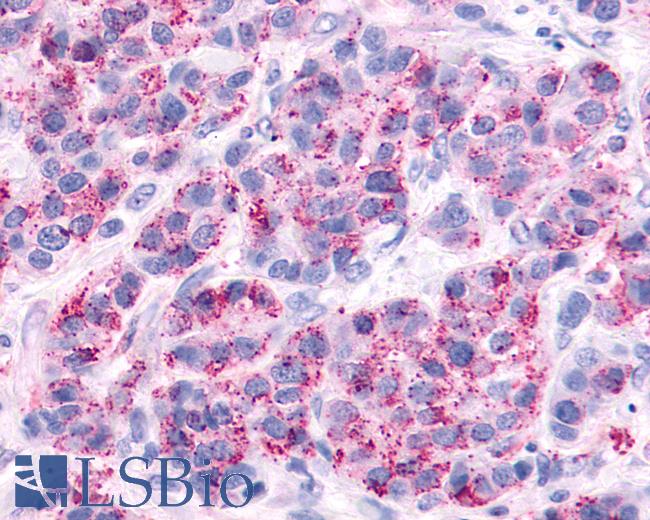 Anti-AVPR2 / V2R antibody IHC of human Breast, Carcinoma. Immunohistochemistry of formalin-fixed, paraffin-embedded tissue after heat-induced antigen retrieval.