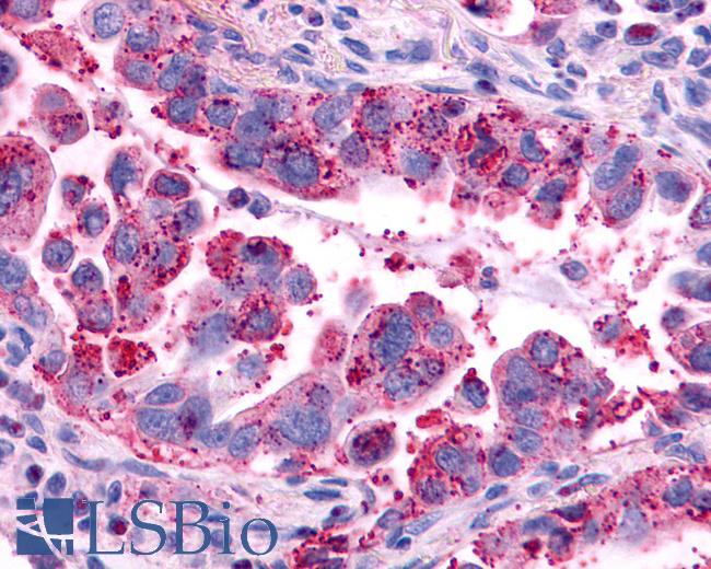 Anti-AVPR2 / V2R antibody IHC of human Lung, Adenocarcinoma. Immunohistochemistry of formalin-fixed, paraffin-embedded tissue after heat-induced antigen retrieval.