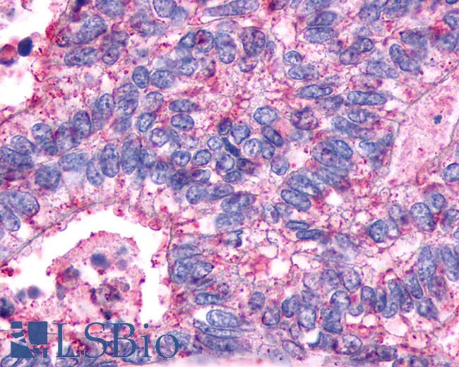 Anti-AVPR2 / V2R antibody IHC of human Colon, Carcinoma. Immunohistochemistry of formalin-fixed, paraffin-embedded tissue after heat-induced antigen retrieval.